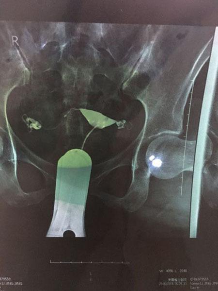 双输卵管 201609051034249143.jpeg